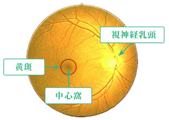 加齢黄斑変性(AMD)の図