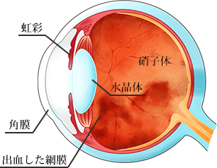 出血した網膜